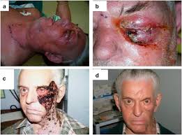 Necrosis is the unnatural death of our cells caused by various things, such as mechanical injury, lack of oxygen, infections, etc. Erythema And Swelling Of Left Side Of Face B Necrosis Of Eyelid Download Scientific Diagram
