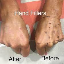 Before And Immediately After Hand Fillers From Our Training Course Last Weekend In Manchester Add Volume And Hydration With Dermal Fillers Add Volume Dry Skin