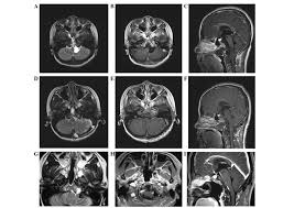 Check spelling or type a new query. Familial Chordoma A Case Report And Review Of The Literature