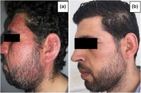 Additionally, other medical conditions that affect people with hiv may trigger excessive hair loss. Demodicosis Revealing An Hiv Infection Sciencedirect
