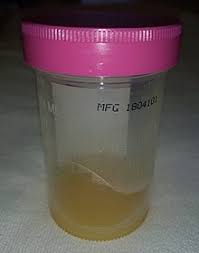 Septic Arthritis Wikipedia