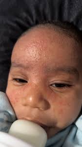 ENGLISH* sharing RECOVERY story of an eczema victim (Im not an eczema  patient) I'll go first first story, This friend i know back in college he  took a huge step in his