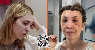 Cleo is unhappy with the results of her facial feminization surgeries and  seeks more procedures…….......See Details in Comment👇👇👇