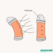 Kromstand penis | Mansani Kliniek