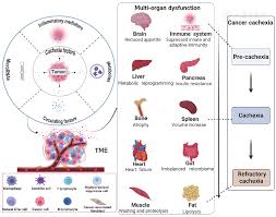 Image result for Cachexia in Cancer