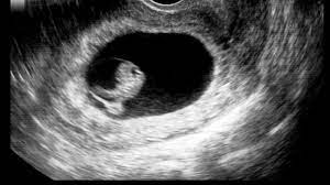 Ssw l placenta praevia l wie erzählt?! 8 Ssw 8 Schwangerschaftswoche Grosse Entwicklung 9monate De