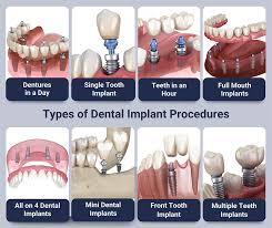 Image result for dental implant