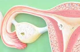 An estimated 22,280 women in the united states will be diagnosed with ovarian cancer this year and 14,240 women will die. Ovarian Cancer And Cysts What Is The Link