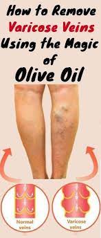 Pin On Varicose Veins