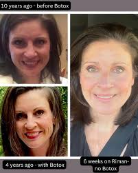 If you think Botox is your ONLY chance at removing some deep lines