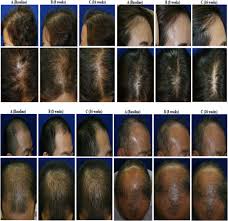 Microneedling is now a therapy that you can use to treat hair loss. Updates Cures For Hair Loss 2021 Follicle Thought