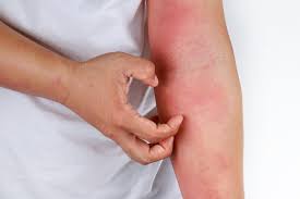 These symptoms typically come on over minutes to hours. Anaphylaxis Allergy Causes Symptoms Diagnosis And Treatments