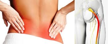 See more of agopuntura e sciatalgia sciatica lombosciatalgia on facebook. Infiammazione Del Nervo Sciatico Cause E Terapie Vivere Senza Dolori