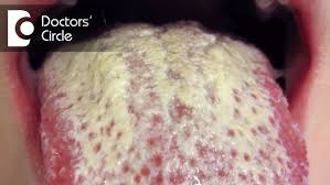 Image result for yellow tongue infection