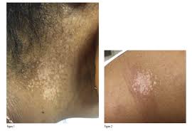 Image result for penis mycosis symptoms