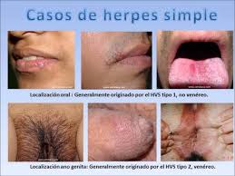 Pata tratar este tipo de enfermedades se recetan fármacos antivirales que puede acelerar la curación y reducir el peligro de padecer dificultades. Jose Luis Lr On Twitter Hilo Sobre El Virus Del Herpes El Herpes Es Una Infeccion Causada Por Un Virus Herpes Simple Vhs El Herpes Bucal Provoca Llagas Alrededor De La