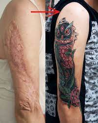 Would recommend weightloss first then body contouring surgery if needed and lastly place the tattoo where you like because it will not be affected by. Is It Okay To Get A Tattoo After Surgery Authoritytattoo