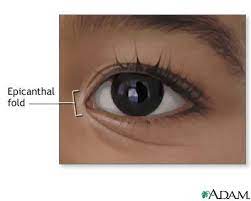In this type of down syndrome, abnormal cell division results in an extra chromosome 21 in each cell. Epicanthal Fold Medlineplus Medical Encyclopedia Image