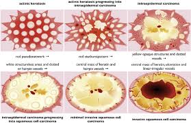 Actinic keratosis, also called solar keratosis, is a precancerous skin lesion usually caused by too much sun exposure. Dermatoscopic Progression Model Of Actinic Keratosis Ak Progressing Download Scientific Diagram