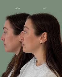 Let's chat about my approach to cheeks! 💌🤍 💌 First, I'll assess if  you're a good candidate and which areas would benefit you most. Everyone's  anatomy is different, and I'll always be