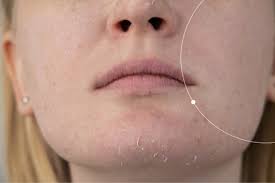 Image result for ekzema face