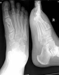 Maybe you would like to learn more about one of these? Foot Injuries Rcemlearning