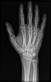 Image result for Capitate Bone