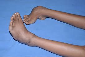 The foot points down and inwards, and the soles of the feet face. Treating Clubfoot In Iraq Driving Through 118 Degree Temperatures By Drew Reynolds Springboard Topics In Global Pediatric Surgery Medium