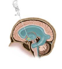 Image result for Hydrocephalus