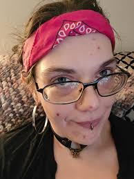 Warped feet in fibro patients, joint damage concerns