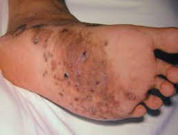 These infections can affect the outer layers of the skin, hair, and nails. Mycetoma Dermnet Nz