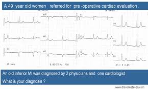 Image result for Q Wave