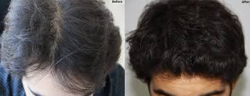 Why is hair loss increasingly common today? Diffuse Thinning Dr Baubac 3 000 Grafts Hair Transplant Result Alvi Armani Beverly Hills