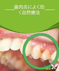 歯周病の自然療法トップ５ みんな健康 自然療法 歯周病 歯石