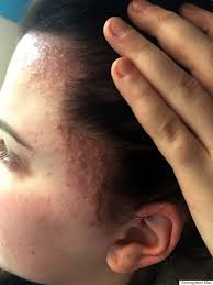 Allergic contact dermatitis is a reaction caused by the skin being touched by something it is allergic to. Sisters Left With Swollen Scab Covered Heads After Allergic Reaction To Salon Hair Dye Huffpost Uk Life