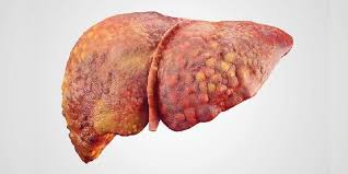 Timbulnya warna kuning pada kulit i, 32% pada trims ii, dan 58.5% pada tiii. Kenali Perbedaan Hepatitis A B Dan C Apa Saja Gejalanya Cantik Tempo Co