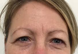 If you don't like the look of these lines, there are home remedies, clinical treatment typically, frown lines are the vertical lines between your eyes, while glabellar lines appear above your eyebrows and run horizontally. Frown Line Treatment Cosmetic Wrinkle Injections