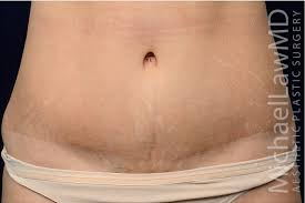 We think that after the tummy tuck surgery, perhaps one can choose to touch up the abdominal tattoo and make it into a new piece of art. Tummy Tuck Scars