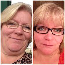 Thyroid hormone is used to treat underactive thyroid (hypothyroidism).it is a natural product made from animal thyroid glands (usually a pig's). Does Armour Thyroid Medication Cause Hair Loss