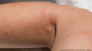 Public service announcements, news releases, and health advisories related to west nile virus. So Schutzen Sie Sich Vor Asiatischen Tiger Und Buschmucken Wissen Umwelt Dw 19 08 2020