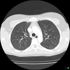 Normal Chest Ct Lung Window Radiology Case Radiopaedia Org Chest Case Lunges