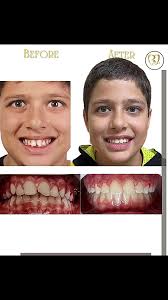 Correction of dental protrusion by fixed orthodontic treatment of the upper  jaw without tooth extraction., رفع جلو زدگی دندانهای فک بالا با ارتودنسی  ثابت فقط فک بالا بدون کشیدن دندان., 👈تغییر را احساس ...