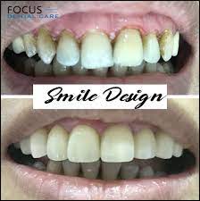 Smile Makeover Clinic In Hyderabad In 2020 Dental Best Dental Implants Dental Implants