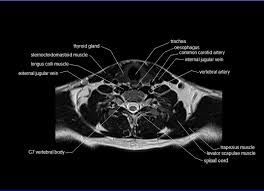 Mri Neck Anatomy Free Mri Axial Neck Cross Sectional Anatomy