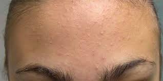 Review Produk Menghilangkan Jerawat Pasir Daripada Shaklee Cara Jesus Shaklee