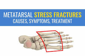 Image result for Metatarsal