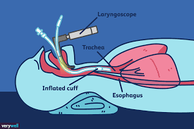 Image result for Intubation Associated Sinusitis