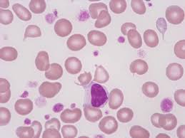 Immunthrombozytopenische purpura, hypersplenie (erhöhte ablagerung in dermilz). Detailansicht Sysmex Deutschland Gmbh