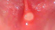 Image result for Canker sores symptoms roof of the mouth