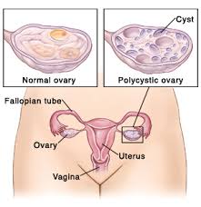 Researches have shown that women with pcos have a high risk of ovarian cancer; When Your Teenager Has Polycystic Ovary Syndrome Pcos Saint Luke S Health System